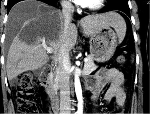 Coronal contrast-enhanced abdominal computed tomography (CT) image of the abdomen, showing the ruptured cyst in the right hepatic lobe and significant hemoperitoneum in the peritoneal cavity, with clear visualization of the disrupted cyst wall and adjacent liver capsule enhancement.