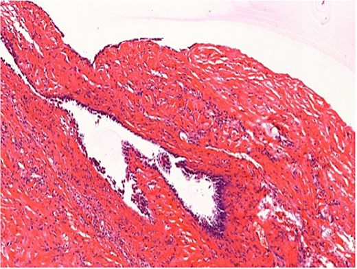 Histopathological image of liver tissue stained with hematoxylin and eosin (H&E) at 200x magnification, confirming the presence of a simple biliary cyst with a thin epithelial lining, no evidence of hydatid disease, parasitic infection, or malignant features.