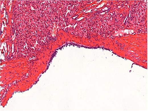 Hematoxylin and eosin (H&E) stained histopathological section of the hepatic cyst at 200x magnification, showing the characteristic morphology of a simple biliary cyst with no hydatid cysts, inflammation, or malignant cells present in the tissue.