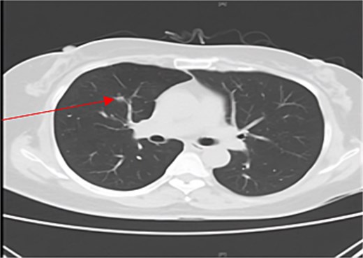 Axial chest CT showing image showing a right middle lobe nodule (arrow)