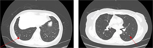 Axial chest CT image showing multiple bilateral pulmonary nodules with representive nodules indicated by arrows