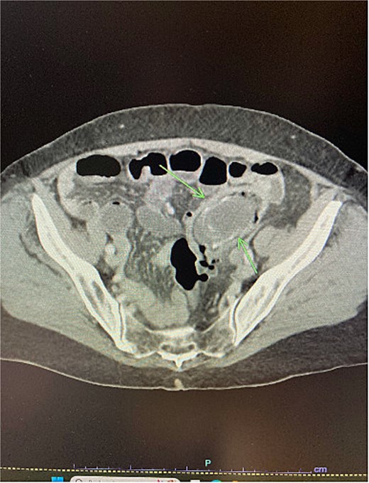 Arrows showing gallstone impacted in the proximal sigmoid colon on CT scan.