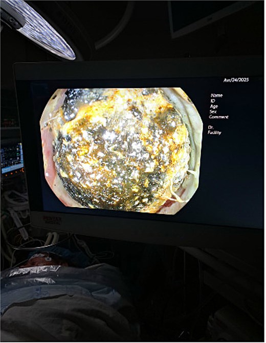 Gallstone located in the proximal impacted in the sigmoid colon identified on colonoscopy.