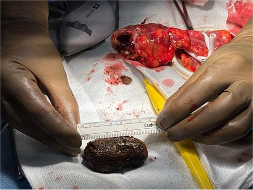 Sigmoid gallstone successfully extracted measuring 6.2 cm.