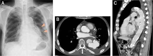 (A) Chest radiograph 3 days before admission showed an abnormal shadow in the left lung field (arrowheads). (B, C) CECT on admission revealed a descending thoracic aortic rupture.
