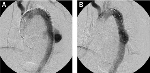 Operative findings. (A) We deployed a Zenith Alpha (32 × 155 mm; W. L. Gore & Associates, Flagstaff, AZ) in the descending aorta, covering the rupture site. (B) The final study confirmed loss of the contrast effect in the aneurysm and no obvious endoleak.