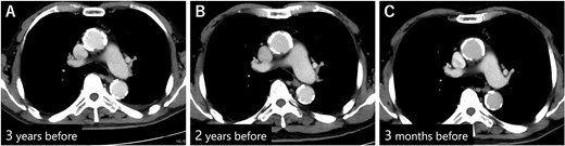 (A) CECT 3 years before presentation showed that the diameter of the descending aorta was 28 mm. (B) CECT 2 years before presentation. (C) CECT 3 months before presentation. Diameter of the descending aorta was unchanged during that period.