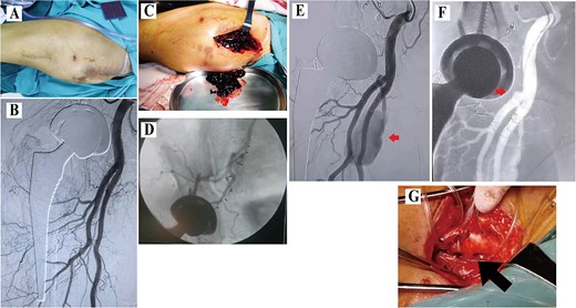 Data of Case 1. (A) Swelling at the proximal thigh; (B)initial DSA showing no pseudoaneurysm; (C) intraoperative hematoma; (D) intraoperative angiography and obturator artery branch embolization using C-arm fluoroscopy; (E) second DSA demonstrating a pseudoaneurysm; (F) failed coil embolization due to tortuosity; (G) surgical ligation.