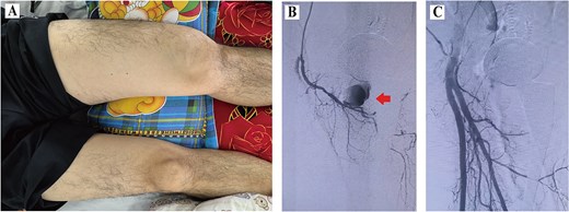 Data of Case 2. (A) Swelling of the left thigh; (B) DSA confirming pseudoaneurysm; (C) post-embolization image.