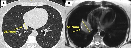 (A) Chest computed tomography from February 2022, showing a right paracardiac lesion reported as a pericardial cyst. (B) Chest MRI from July 2025 showing the same lesion as a well-defined oval mass with clear interval growth.
