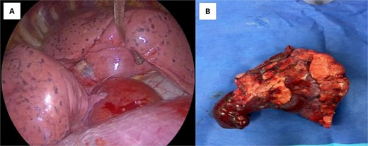 (A) Intraoperative image of the tumor in situ. (B) Resected tumor specimen.