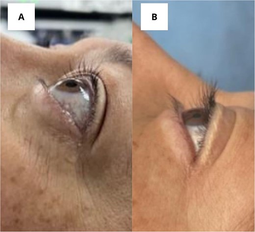(A) Photograph taken before surgery. (B) Photograph taken 2 weeks after surgery.
