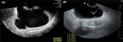 Pelvic ultrasound revealing predominantly cystic mass. (A) A 10 cm sized cystic lesion posterior to the bladder. (B) An increased sized mass with newly formed 2 mm-thick vascular septum.