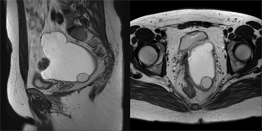 T2-weighted imaging demonstrating cystic components with various hyperintense signals.