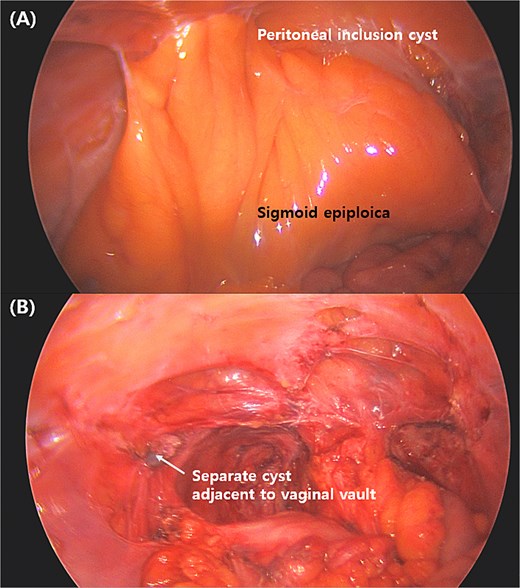 Intraoperative images showing detailed cystic structure in the posterior cul-de-sac. (A) A thin peritoneal film overlying pelvic cavity upon entering the abdomen. (B) Abdominal anatomy after draining the PIC.