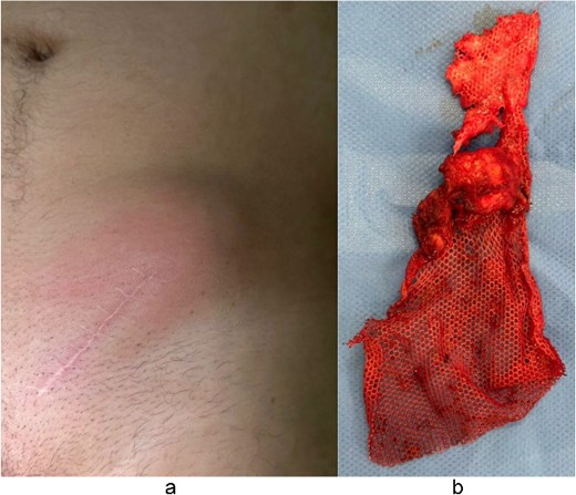 (a) Clinical symptoms of inflammation regarding inguinal hernia scar. (b) Removed hernia mesh after surgical intervention.