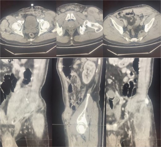 Abdominal pelvic CT-scan showing inflammation around the left inguinal mesh with infiltration and thickening around the adjacent parietal soft tissues and multiple collections surrounding the mesh and along the ipsilateral iliopsoas and sartorius muscles.