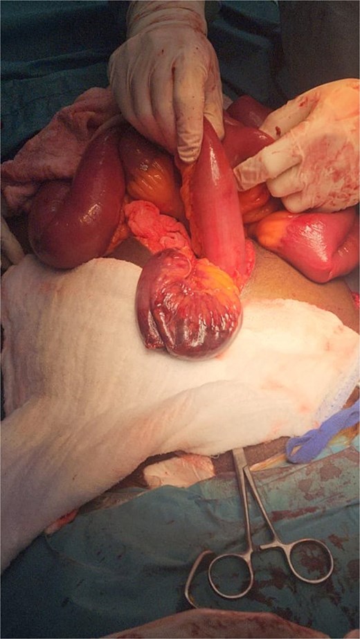 Gangrenous small bowel segment intraoperatively.