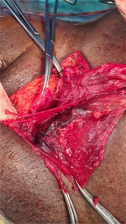 Hernia sac with ischemic changes.