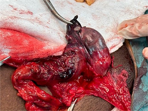 Gangrenous testis and spermatic cord.