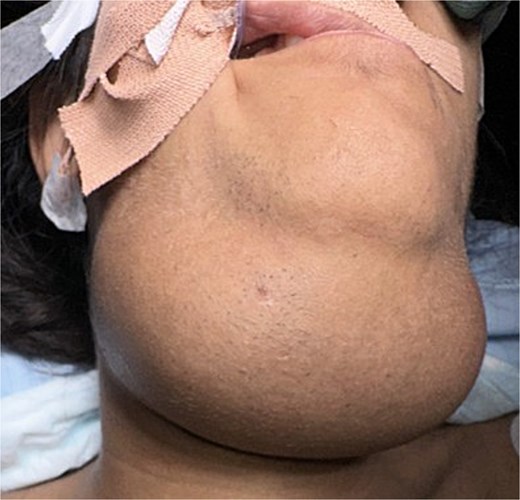 Preoperative facial view showing large midline neck mass.