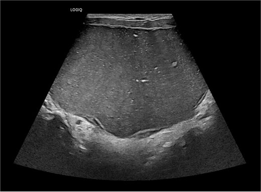 Ultrasound of neck showing large well defined cystic midline lesion involving floor of mouth.