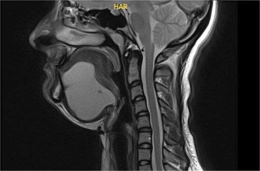 MRI neck with contrast showing a bi-lobed cystic mass extending to tongue base.