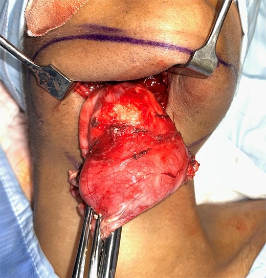 Intraoperative view of dissected specimen.