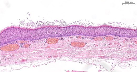 Histology showing orthokeratinizing epithelium lined cyst wall that is devoid of cutaneous appendages, the typical appearance of an epidermoid cyst.