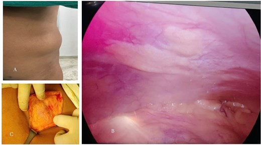 (A) Preoperative clinical photograph showing a reducible swelling over the left lower abdominal wall along the semilunar line (Spigelian belt region). (B) Laparoscopic view demonstrating intact peritoneum without visible hernia sac or defect. (C) Open intraoperative image revealing a 2 × 3 cm defect in the left Spigelian aponeurosis containing preperitoneal lipomatous tissue without a peritoneal sac, consistent with a sacless Spigelian hernia.