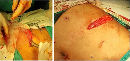 (A, B) Placement of polypropylene mesh in the preperitoneal (sublay) plane adequately covering the defect.