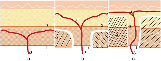 Illustration of the technique. (a) The perforator branching below the superficial fascia is not a candidate for thinning. (b) The perforator branches diagonally to both sides through the superficial fascia and can only be primarily thinned. The fascia island is left at 2–4 cm. (c) The perforator branches running perpendicular to the skin can be microdissected and thinned. The fascia island retains 1–2 cm.
