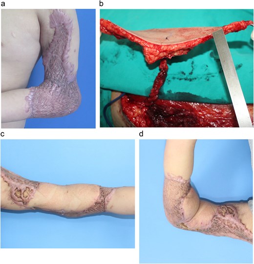 (a) Extensive post-burn contracture of the elbow with severe range-of-motion limitation. (b) Harvest of the ALT flap, showing the isolated vascular perforator. (c, d) Postoperative results show successful coverage and restoration of elbow function.