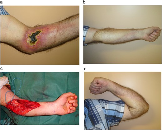 (a) The radial ulcer of the anterior elbow site. The patient experienced severe pain and significant functional sequelae, particularly limitation of elbow mobility. (b) The defect after resection was extensive. The elbow then received a 22 × 10 cm ALT flap, harvested without primary thinning, to cover the elbow defect. (c, d) Result after 2-year follow-up. The patient demonstrated excellent aesthetic and functional outcomes, with no recurrence of necrosis, a common complication of such radiation injuries.