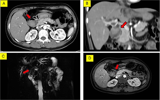 A composite of four preoperative imaging scans of a hilar lesion. Panel A shows an axial MSCT scan with a visible mass. Panel B shows a coronal MSCT scan demonstrating the lesion's extent. Panel C displays a 3D reconstruction of the biliary tree indicating the tumor's location. Panel D shows an axial T1-weighted MRI scan of the lesion.