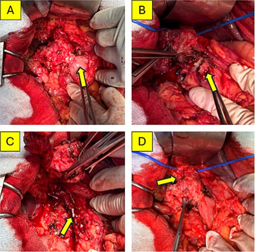 Four intraoperative photographs. Panel A shows the duodenum densely adherent to the cyst. Panel B shows the duodenal defect after wedge resection. Panel C displays the atrophic distal common bile duct. Panel D shows the dissection of the mass from the portal vein.