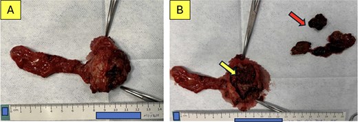 Two photographs of the surgical specimen. Panel A shows the en bloc resected specimen intact. Panel B shows the opened cyst revealing malignant tissue, food debris, and biliary stones within the lumen.