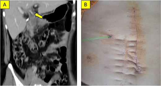 Two images showing postoperative outcomes. Panel A is a coronal MSCT scan at 4 weeks post-surgery showing a transanastomotic stent. Panel B is a clinical photograph of the healed abdominal incision and external biliary drain.