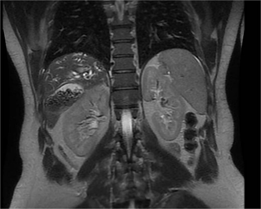 Shows a coronal MRCP image demonstrating an abnormally positioned subhepatic gallbladder located inferior to the liver margin, with visualization of the biliary tree.