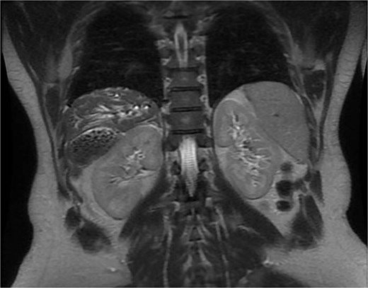 Shows a Coronal MRCP image showing a distended gallbladder with multiple gallstones and an impacted stone at the neck, with dilatation of the common bile duct and intrahepatic biliary radicles.