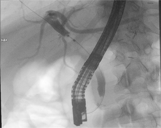 Shows an ERCP fluoroscopic image showing contrast filling of the biliary tree with a filling defect in the distal common bile duct.
