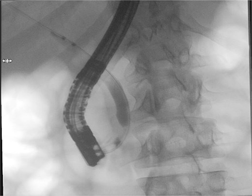 Shows a fluoroscopic ERCP image demonstrating successful biliary sphincterotomy, balloon stone extraction, and placement of a biliary stent within the common bile duct.