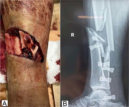 Clinical photograph and radiograph of a severe open distal tibial fracture with soft-tissue loss and segmental bone defect in the right leg.