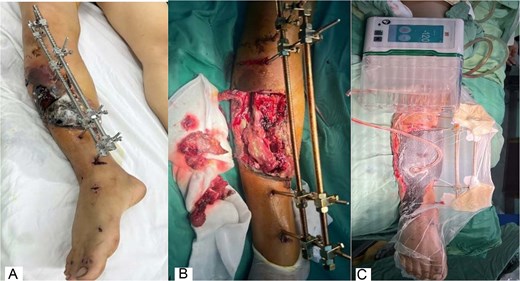 Serial clinical photographs showing wound progression after debridement, extensive soft-tissue necrosis with exposed tibia, and circumferential negative-pressure wound therapy applied around the leg and external fixator.