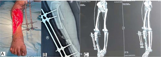 Clinical and radiologic images showing granulation tissue formation and postoperative bony reconstruction with a pedicled fibular graft bridging the tibial defect under external fixation.