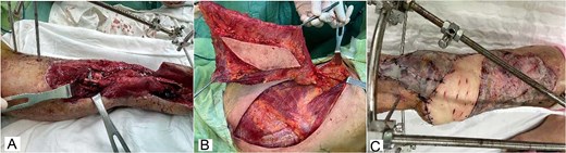 Intraoperative and early postoperative images of latissimus dorsi free flap transfer, including microvascular anastomosis, flap harvest, and soft-tissue coverage of the lower leg.