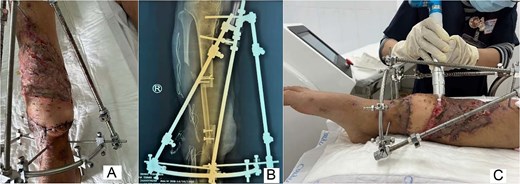 Late postoperative clinical, radiographic, and wound-care images showing stable flap healing, maintained alignment of the tibia, and adjunctive plasma therapy over the skin-grafted area.