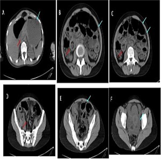 Serial images from the patient computed tomography abdominal scan that showed terminal ileum wall thickening contributing to luminal narrowing, along with surrounding fat stranding and mesenteric congestion which is associated with some adjacent prominent lymph nodes. There is few foci of extraluminal free gas reflecting bowel perforation, in addition to free fluid in the pelvis and paracolic gutters. Despite the presence of some bowel dilatation no complete bowel obstruction and the rectum lumen is preserved.