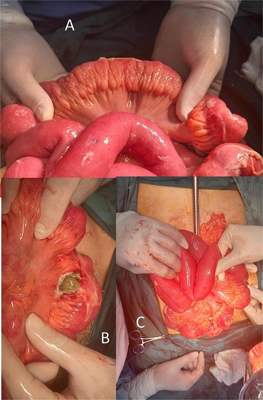 Fat creeping, ileal perforation, lymph nodes (mesenteric lymphadenitis).