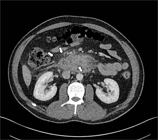 Axial contrast-enhanced CT scan of the upper abdomen showing a thickened, edematous duodenal wall and inflammatory fat stranding in the pancreaticoduodenal groove. White arrows indicate prominent reactive mesenteric lymphadenopathy and soft tissue swelling adjacent to the pancreatic head and duodenal C-loop